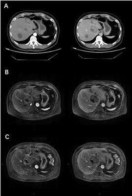 Complete Response After Pre-Operative Transcatheter Arterial Chemoembolization for Unresectable Primary Hepatic Neuroendocrine Tumour: A Case Report and Literature Review